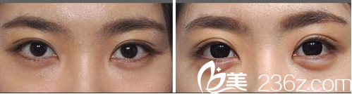 GOOD FILLER整形外科案例 GOOD FILLER整形外科案例