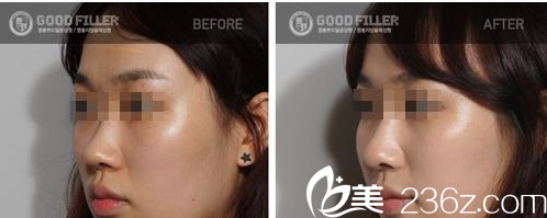 GOOD FILLER整形外科案例 GOOD FILLER整形外科案例