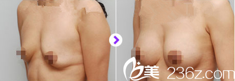 金允石院长矫正下垂胸部真人案例 金允石院长矫正下垂胸部真人案例