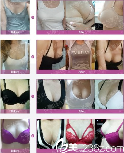 KOREA整形三无立体隆胸真人案例 KOREA整形三无立体隆胸真人案例