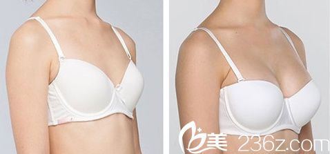 金允石院长假体隆胸前后对比图 金允石院长假体隆胸前后对比图