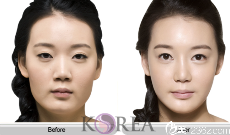 韩国KOREA整形崔相錄院长Vline案例 韩国KOREA整形崔相錄院长Vline案例