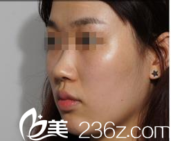 GOOD FILLER整形外科案例 GOOD FILLER整形外科案例