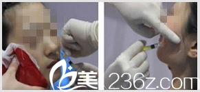 GOOD FILLER整形外科案例 GOOD FILLER整形外科案例