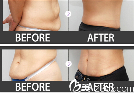 姜民赫院长腹部吸脂手术真人案例 姜民赫院长腹部吸脂手术真人案例