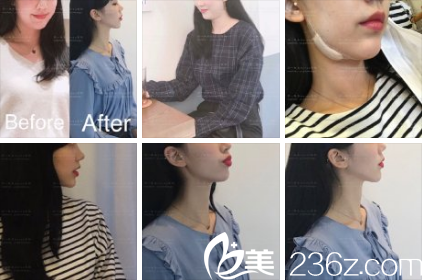 KOREA整形外科张瑞允下巴吸脂+提升 KOREA整形外科张瑞允下巴吸脂+提升