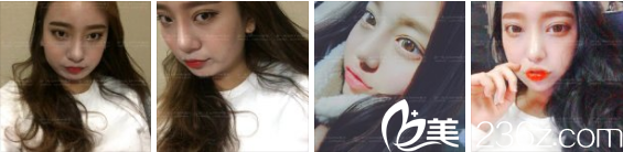 张瑞允院长开眼角+面部轮廓手术 张瑞允院长开眼角+面部轮廓手术