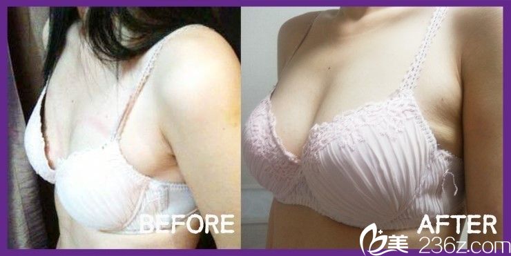 姜民赫院长假体隆胸真人案例