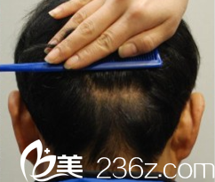 韩国狎鸥亭延世医院毛发移植术后