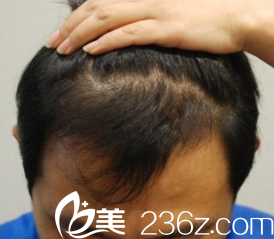 金大溶院长毛发移植术后5个月
