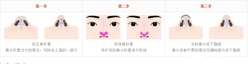 鼻头软骨整形手术过程 鼻头软骨整形手术过程