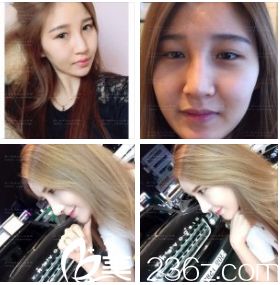 金享俊院长鼻部整形真人案例 金享俊院长鼻部整形真人案例