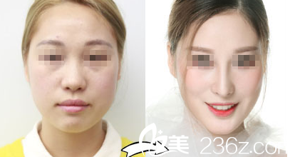 重庆华美双眼皮案例 重庆华美双眼皮案例