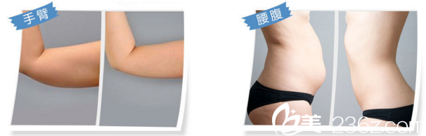 重庆华美吸脂整形真人案例 重庆华美吸脂整形真人案例