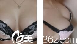 韩国optima整形外科李安娜隆胸效果怎么样？假体隆胸真人案例