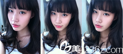 韩国狎鸥亭YK整形外科做面部轮廓怎们样？真人案例