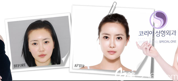 韩国KOREA整形外科申承翰真人案例 韩国KOREA整形外科申承翰真人案例