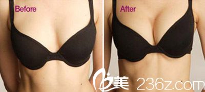 韩国妩丽整形外科假体隆胸真人案例 韩国妩丽整形外科假体隆胸真人案例