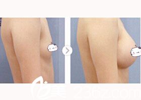 金允石院长假体隆胸前后对比 金允石院长假体隆胸前后对比