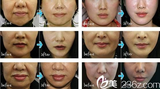 禹政浩院长亲自手术术后效果 禹政浩院长亲自手术术后效果