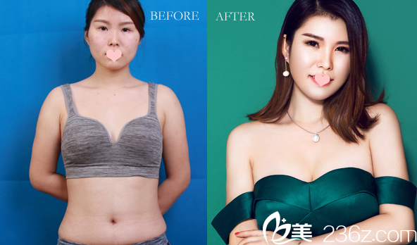 广州美莱整形医院<!--<i data=20240703-sp></i>-->做的内窥镜假体隆胸效果图