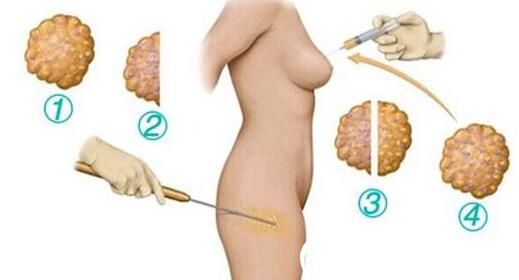 韩国伊美芝整形医院自体脂肪移植