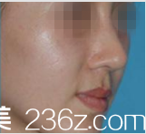 分享我在Beauty Line 4U整形做驼峰鼻一个月恢复照，朴成龙院长案例