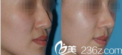 Beauty Line 4U整形外科医院案例