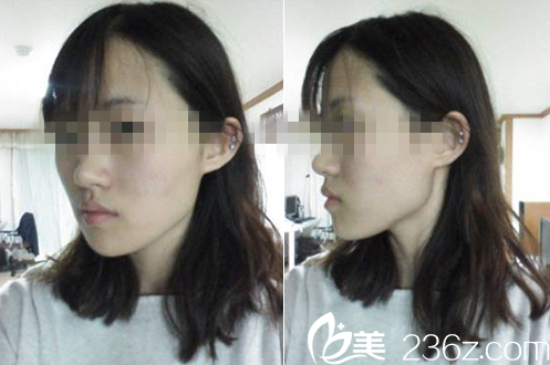韩国妩丽整形外科术前素颜照
