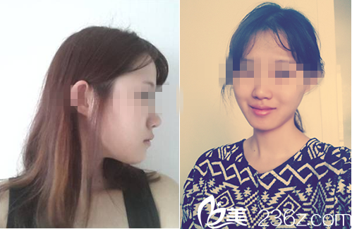 妩丽医院真人案例3周后