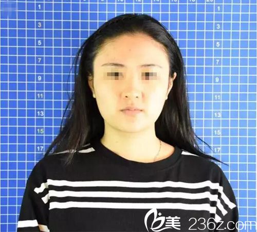 术前效果 术前效果