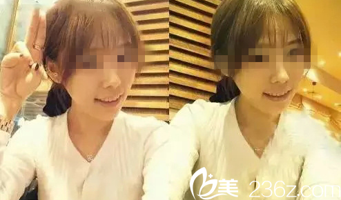 妩丽医院术后一个月真人案例