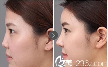 华美爱贝芙注射填充效果 华美爱贝芙注射填充效果