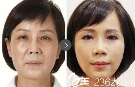 王毅超注射爱贝芙除皱效果 王毅超注射爱贝芙除皱效果