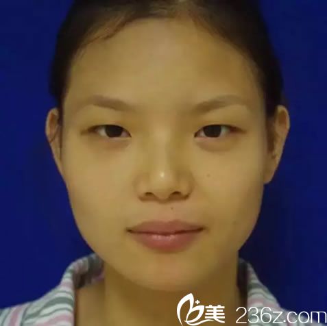 做手术前的单眼皮塌鼻梁 做手术前的单眼皮塌鼻梁