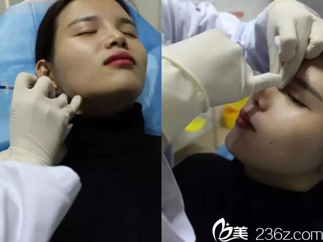 做注射隆鼻和瘦脸的过程图 做注射隆鼻和瘦脸的过程图