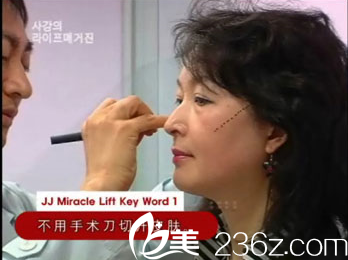 美来可整形医院面部提升术无需动刀 美来可整形医院面部提升术无需动刀