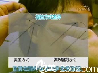 美来可整形医院禹政浩先进的提拉方式 美来可整形医院禹政浩先进的提拉方式