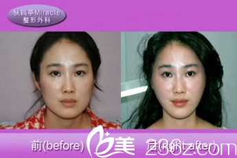 美来可整形医院禹政浩面部提升术效果对比 美来可整形医院禹政浩面部提升术效果对比