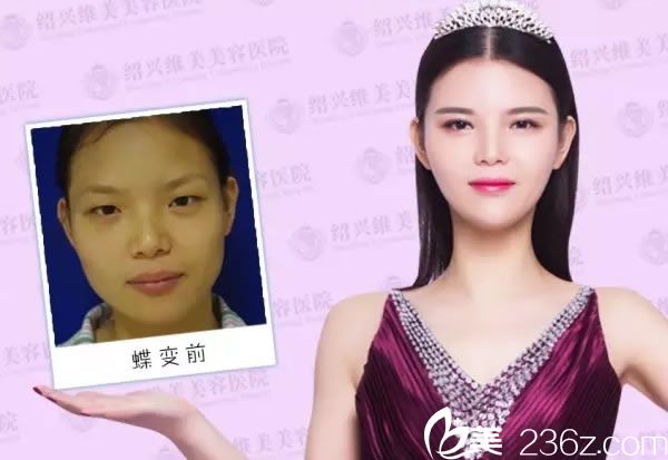 术前术后的效果对比图 术前术后的效果对比图