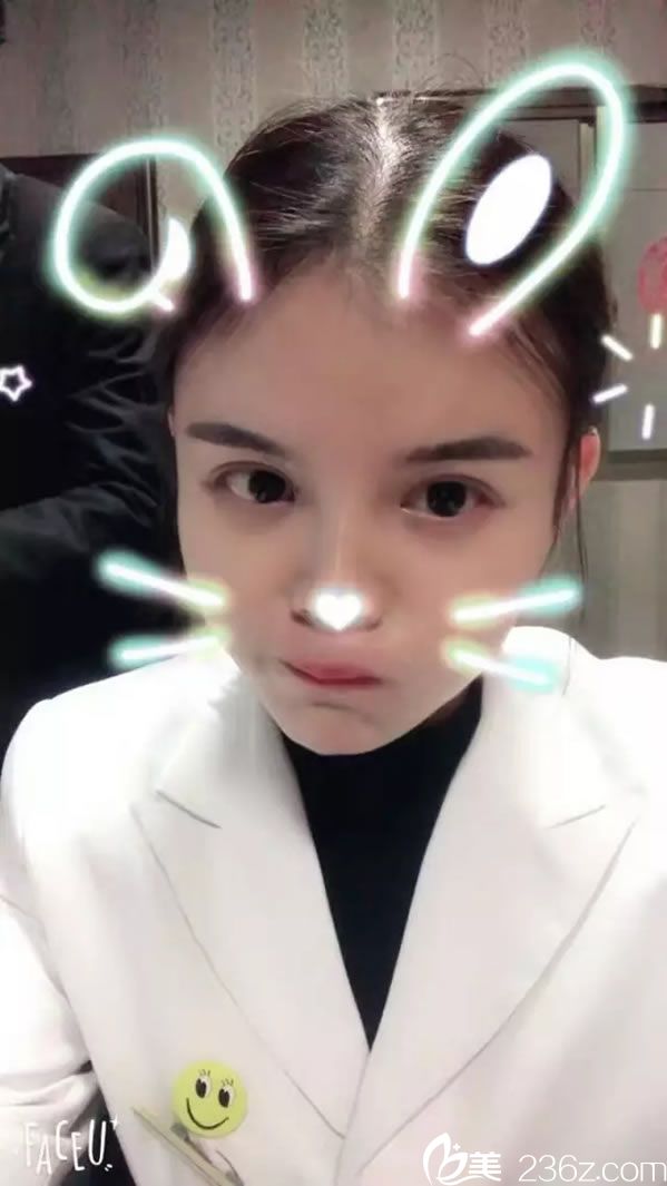 韩兴斌双眼皮真人案例效果图 韩兴斌双眼皮真人案例效果图