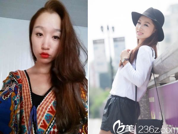 绍兴维美李杰主任的美肤真人案例 绍兴维美李杰主任的美肤真人案例