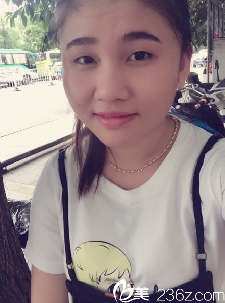 在维美做韩式双眼皮手术前 在维美做韩式双眼皮手术前