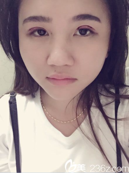 绍兴维美汪峰韩式三点双眼皮第1天 绍兴维美汪峰韩式三点双眼皮第1天