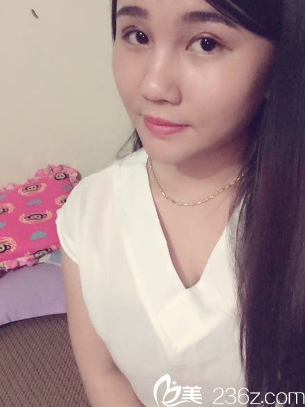 维美做韩式双眼皮第6天恢复照 维美做韩式双眼皮第6天恢复照