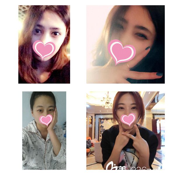 张新枝主任做双眼皮案例