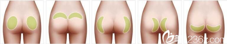 韩国美姿整形外科医院提臀术 韩国美姿整形外科医院提臀术