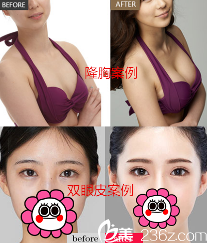 重庆华美李富强院长真人隆胸双眼皮案例 重庆华美李富强院长真人隆胸双眼皮案例