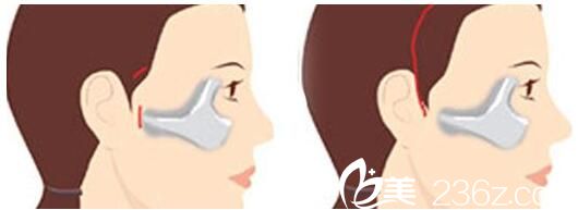 韩国美姿整形外科医院颧骨降低术 韩国美姿整形外科医院颧骨降低术