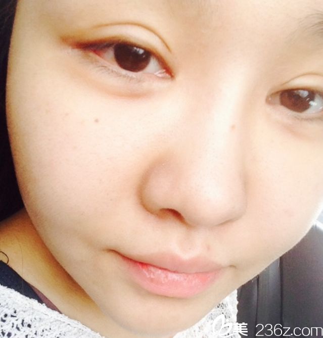 韩国美佳整形美容医院柳元敏院长做眼睛怎么样? 韩国美佳整形美容医院柳元敏院长做眼睛怎么样?